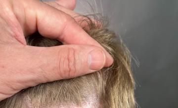 Dr. Arocha | 3000 graft FUT + 2500 graft FUE