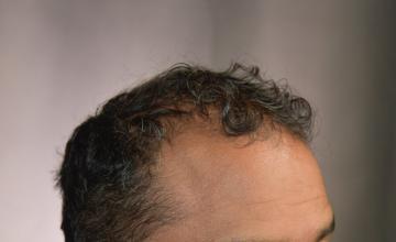 Dr. Arocha | PRP + 2400 Graft FUE