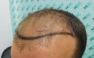 Hair Transplant Result - 15 months after for 4000 FUE Grafts on NW5 Patient – HDC hair Clinic – Dr Maras