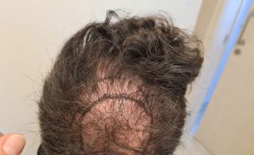 Crown Result of 3rd FUE for 2410 Grafts – HDC Hair Clinic