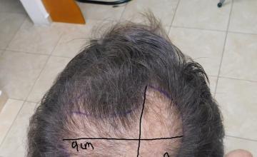 2400 Grafts Crown Result – 9 Months After – HDC Hair Clinic – Dr Maras