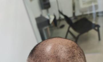 FUE repair Result after 6026 Grafts in two Sessions – HDC Hair Clinic – Dr Maras
