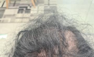 Result of 4000 Dense grafts – 1 year after – HDC Hair Clinic – Dr Maras