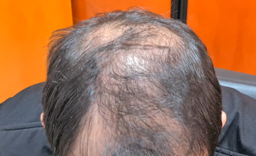 Result of 4000 grafts – 11 months after – NW class 4