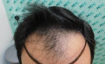 Dr Christina - Before and after 3520 FUE Grafts – 8 months after – HDC Hair Clinic