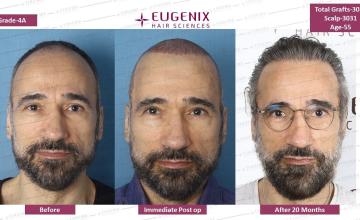 Why patients across the globe trust Eugenix-India for their hair restoration ?