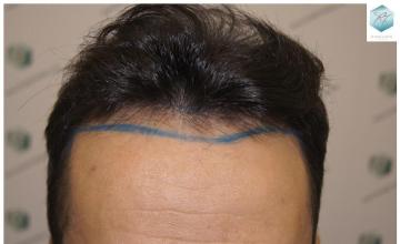 Dr. Rafael de Freitas - 2.077 Grafts - 5.647 Hairs