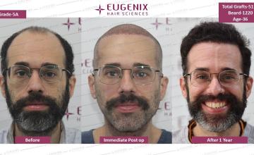 Amazingly Transformational Hair Transplant Journey | Juan from Madrid, Spain | NW 5A 5110 grafts