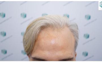 Dr. Rafael de Freitas - 2803 Grafts / 6691 Hairs - FUE