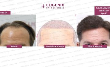 Caucacian Hair: 5 months update @Eugenix Hair Sciences
