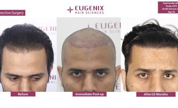 Corrective Hair Transplantation | Hairline Correction I 7 months update @Eugenix Hair Sciences