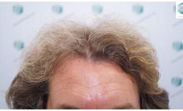 Dr. Rafael de Freitas - 3.164 Grafts / 7466 Hairs - FUE