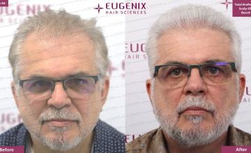 Latin-American Patient Transformation @ Eugenix Hair Sciences | 5 Month Results | 3510 Grafts