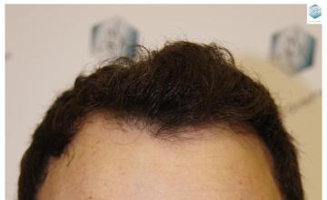 Dr. Rafael de Freitas - 2094 Grafts - FUE