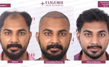 Restoring Hair and Confidence, With Eugenix Precision | 4500 Grafts | 8 Months Results