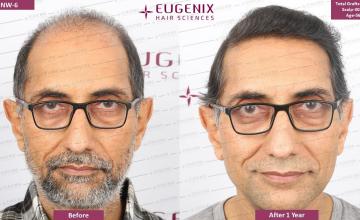 Trust Only the Specialists for Corrective Hair Restoration Procedures | Eugenix Hair Sciences