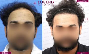 Norwood Grade 3V Baldness Hair Transplant | 20 Months Update - 3012 Grafts @Eugenix Hair Sciences