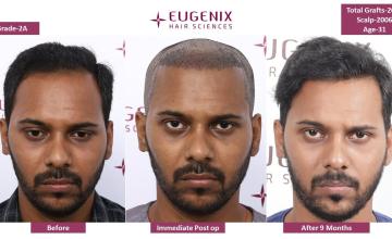 Hairline restoration @ Eugenix | 2006 grafts | 9 month results