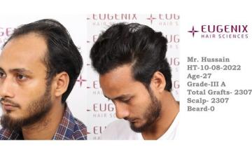 EUGENIX HAIR SCEINCES | GRADE 3A | 9 MONTHS RESULT