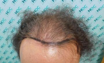 Hair Transplant Outcome with 4000 Grafts Across NW5 Zone – HDC Hair Clinic