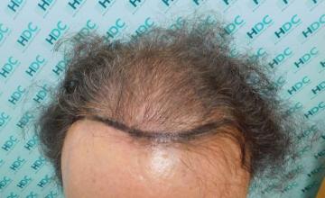 Hair Transplant Outcome with 4000 Grafts Across NW5 Zone – HDC Hair Clinic