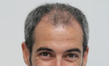 Dr Resul Yaman Hair Clinic - 4150 Grafts - 6 Years Result