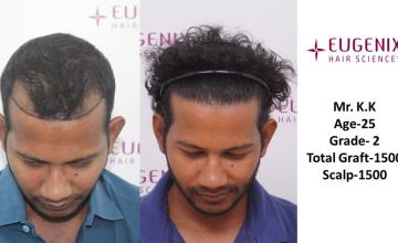 Dr. Somesh | Eugenix Hair Transplant Clinic | NW 2 | 1500 Grafts | 16 Months Post-Op
