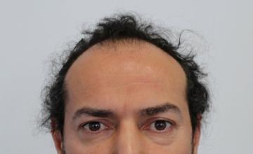 Dr Resul Yaman Hair Clinic - 3920 Grafts Result