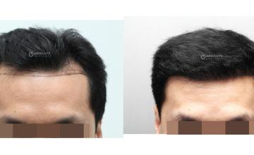 Dr. Kongkiat Laorwong, MD, FISHRS,  FUE 2000 grafts hairline