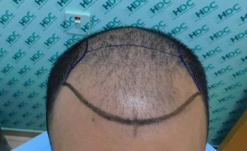 FUE Result from HDC Hair Clinic – 21 months after- 3300 Grafts