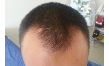 Dr Resul Yaman Hair Clinic - 3100 Grafts - 10 Years Result
