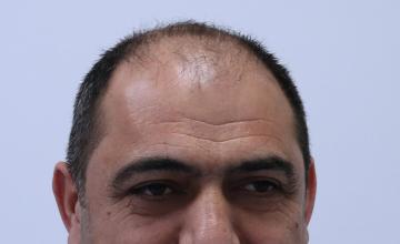 Dr Resul Yaman Hair Clinic - 4670 Grafts Result