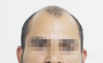 Dr. Suneet Soni - 4300 Grafts, Combine FUT + FUE Technique , NW-VII