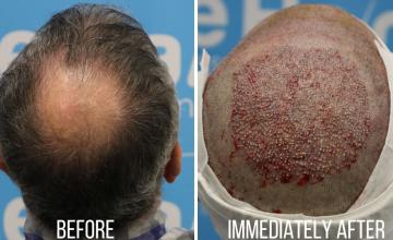 Crown case - FUE Dr Arshad. 2020 grafts. 10 months post procedure.