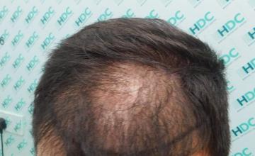 FUE Hair Transplant Result for 3100 Grafts - NW3 – 8 Months After – HDC Hair Clinic