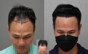 Dr. Kongkiat Laorwong, MD, FISHRS,  FUE 2500 grafts, 7 months post op