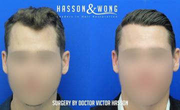 Dr. Hasson / 2215 grafts / hairline / FUE / 1 year post-op