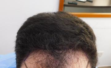 Hair Transplant result – 7 months after – 3200 FUE Grafts - NW class 3 - Dr Christina HDC