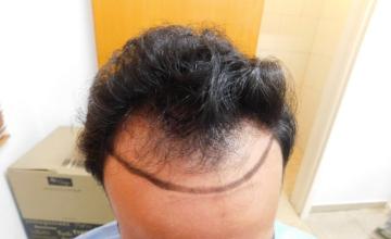 FUE Result for hairline and temples – 1 Year after 2980 grafts – HDC Hair Clinic