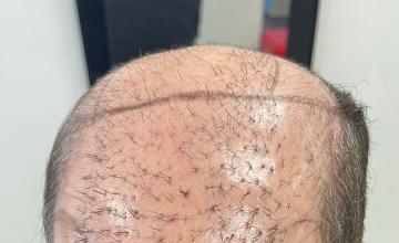 Major Repair of Mini Grafts - Result: 4160 Grafts – HDC Hair Clinic