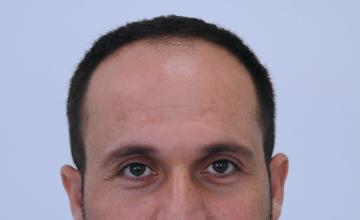 Dr Resul Yaman Hair Clinic - 4170 Grafts Result