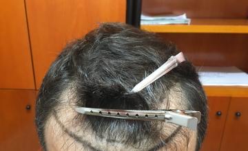 Hairline and crown - 4000 FUE Grafts – Dr Christina – HDC Hair Clinic