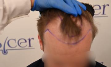 Ozlem Bicer MD-Hair Transplant-2720 Grafts FUE by micro-motor, 9. months result