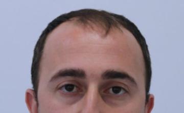 Dr Resul Yaman Hair Clinic - 4740 Grafts Result