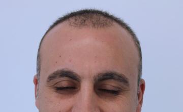 Dr Resul Yaman Hair Clinic - 4060 Grafts Result