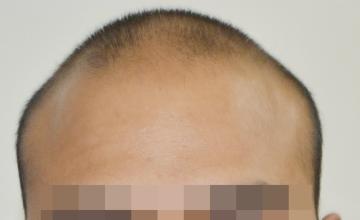 Dr. Suneet Soni - 7400 FUT Grafts, NW VI, 2 Sittings