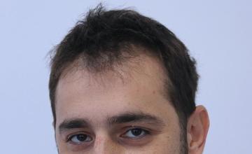Dr Resul Yaman Hair Clinic - 2890 Grafts Result