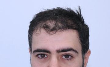 Dr Resul Yaman Hair Clinic - 2960 Grafts Result