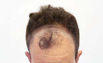 Dr Resul Yaman Hair Clinic - 3560 Grafts Result