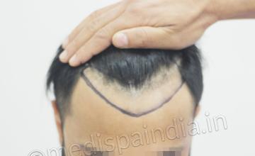 Dr. Suneet Soni - Grafts ~2650, FUT Technique , NW-III